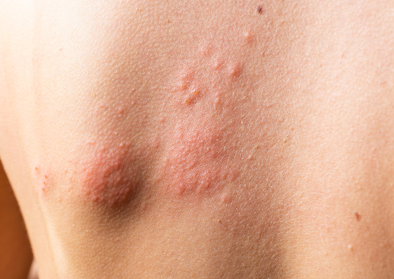 Urticaria Skin Treatment Image